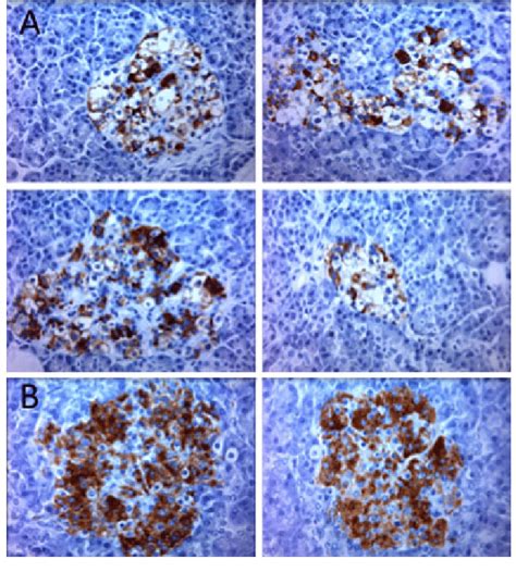 Hydropic degeneration in islets from the donor that died at onset of... | Download Scientific ...