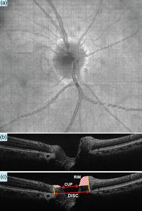 A horizontal B-scan OCT image crossing the center of the optic nerve ...