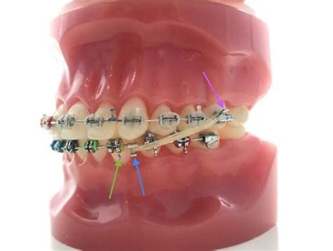 What Are Orthodontic Elastics (Rubber Bands) And How Do