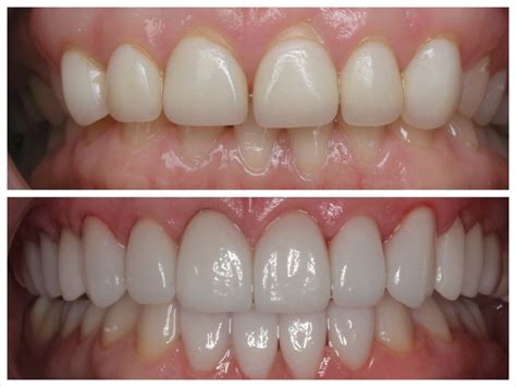 Porcelain Veneers in Glendale | Verdugo Hills Dental Group