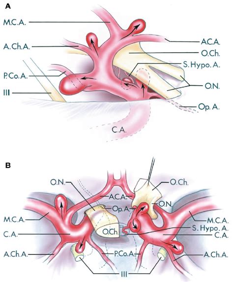 Lateral and Superior Views of Common Aneurysm Sites on the Supraclinoid Portion of the Internal ...