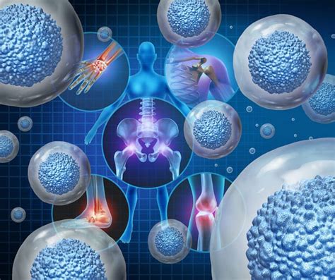 Who Makes the Ideal Candidate for Stem Cell Therapy?