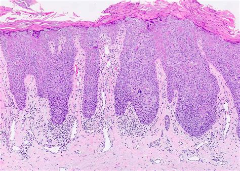 Squamous Cell Carcinoma In Situ Histology – NBKomputer