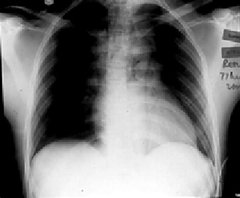 Pneumomediastinum secondary to an apparently trivial stab wound to the neck: the value of the ...