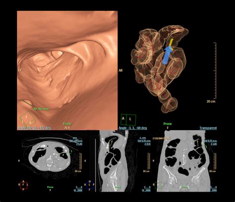 CT colonography potentially less expensive than optical colonoscopy: study