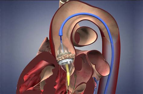 Aortic Valve Replacement Now Made Very Simple - ehealth quotes