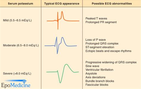 emDOCs.net – Emergency Medicine EducationECG Pointers: Hyperkalemia ...