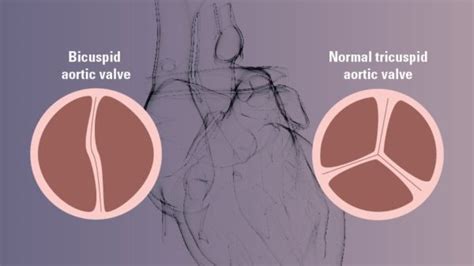 What is a Bicuspid Aortic Valve? - Cardiovascular Interventions Orlando