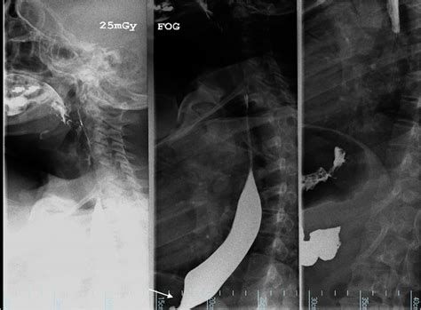 Pre-Operatively Esophageal Motility Test (Cinedeglution). Narrowing of... | Download Scientific ...