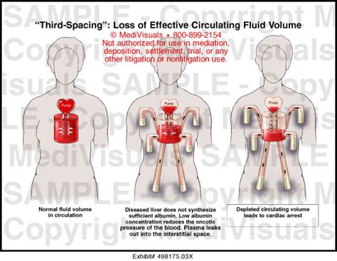 Third-Spacing Loss of Effective Circulating Fluid Volume MediVisuals