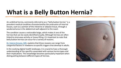 Belly Button Hernia: A Quick Guide! - Speaker Deck