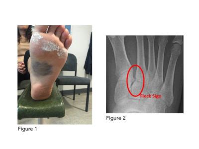 Cuneiform Bone Fracture