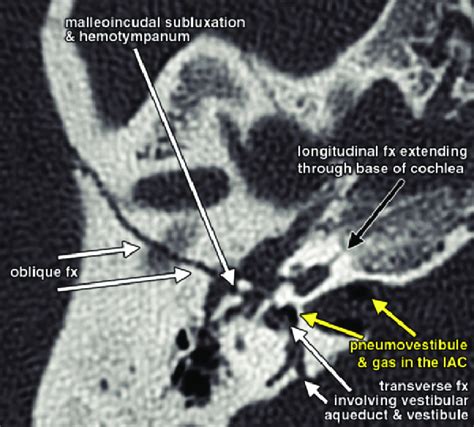 Types Of Temporal Bone Fracture