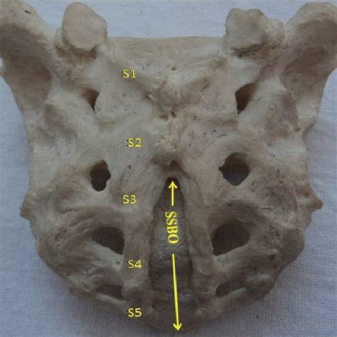 Shows type-IV SSBO. Here the level of apex of sacrum is at S3 vertebra.... | Download Scientific ...