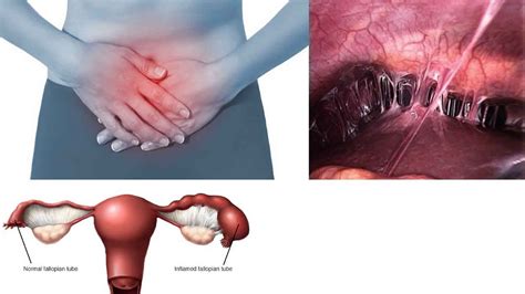 Pelvic inflammatory disease causes, symptoms, diagnosis, treatment & cure