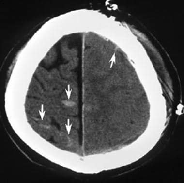 Brain Contusion Imaging: Practice Essentials, Computed Tomography, Magnetic Resonance Imaging