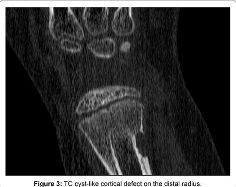 [PDF] Cyst-Like Cortical Defects Following Fractures in Children: Series of 5 Cases | Semantic ...