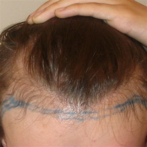 Female Pattern Baldness Receding Hairline