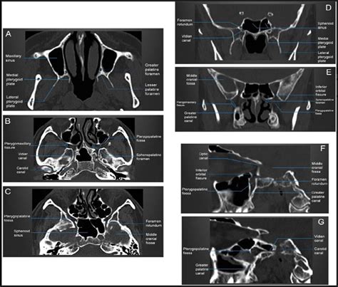 Inferior Orbital Fissure Pterygopalatine Fossa