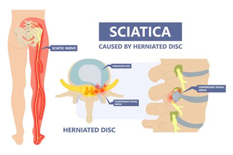 Sciatica (Lumbar Radiculopathy) - Tidewater Physicians Multispecialty Group