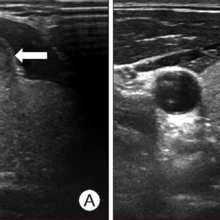 Profile photo. 1.5 cm sized movable, round mass in mid-anterior neck,... | Download Scientific ...