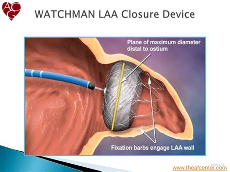 Afib and Stroke Prevention - Left Atrial Appendage Occlusion with Wat…