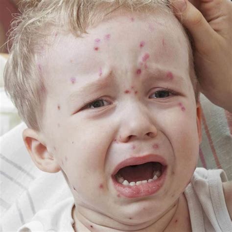 Symptoms of chickenpox in babies pictures | Symptoms and pictures