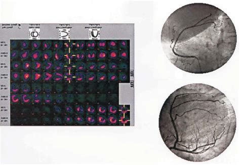 Dipyridamole thallium scan showed irreversible change in the... | Download Scientific Diagram