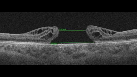 Vitrectomy for a very large macular hole (2222 µm) - YouTube