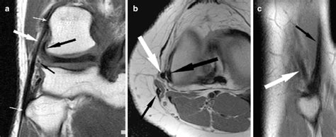 Normal lateral collateral ligament (LCL). T1-weighted coronal (a),... | Download Scientific Diagram