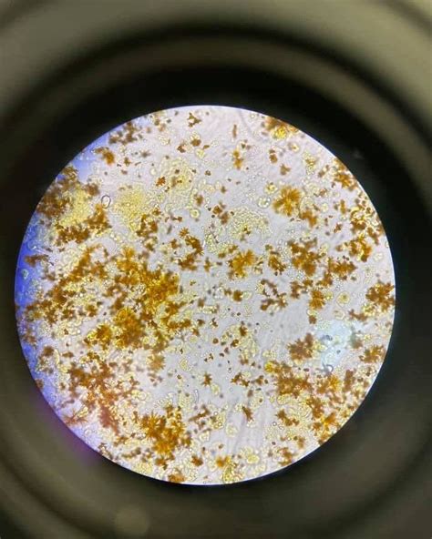 Tyrosine Crystals In Urine