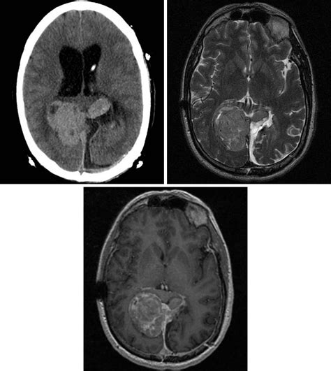 Hemangiopericytoma | The Neurosurgical Atlas