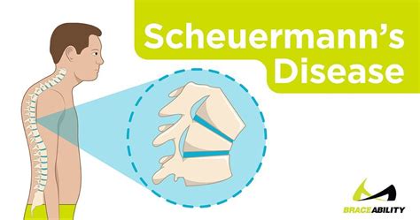 Everything You Ever Wanted to Know About Scheuermann’s Disease… from Schmorl’s Nodes to Bracing ...