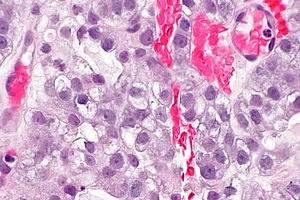 Clear cell carcinoma of the uterine cervix - Libre Pathology