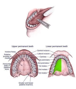 How is the lingual nerve block performed?