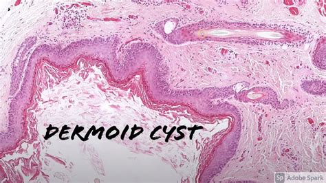 Dermoid Cyst: 5-Minute Pathology Pearls - YouTube