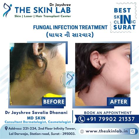 Fungal Skin Infection Specialist in Surat - Dr Jayshree Savalia