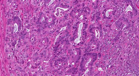 Invasive adenocarcinoma of the colon and rectum | MyPathologyReport.ca