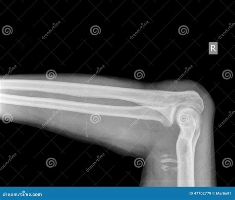 X-ray Of Arm Stock Photo - Image: 47702779