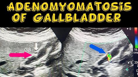 Adenomyomatosis of Gallbladder - YouTube