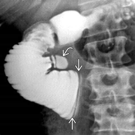 SMA Syndrome | Radiology Key