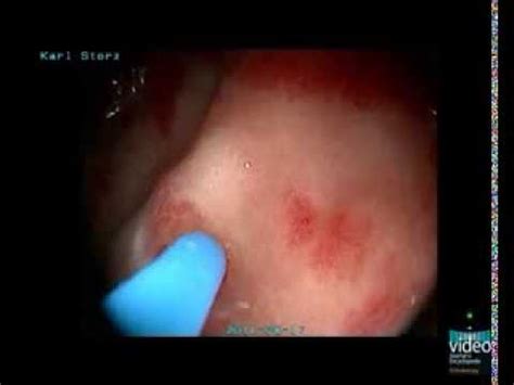 Gastric Antral Vascular Ectasias: A Rare but Relevant Entity - YouTube