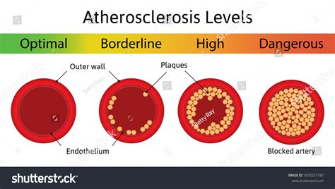 Atherosclerosis Stages