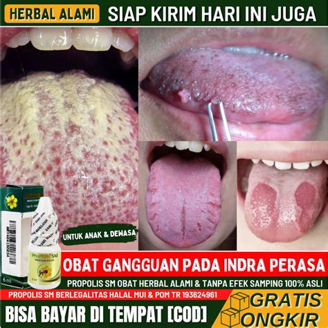 Jual Obat Lidah Berubah Bentuk, Lidah Abnormal, Sariawan di Lidah, Obat ...