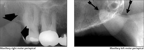 Pterygoid Plate Radiograph