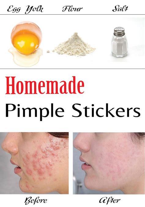 Homemade Pimple Stickers | Pimples, Homemade, How to treat acne