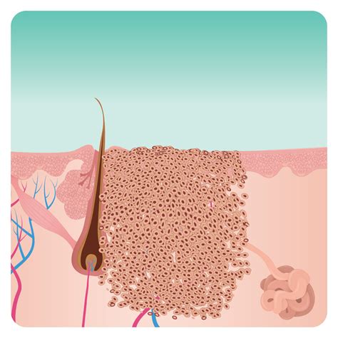 Swift Verruca Treatment - Foot Mechanics