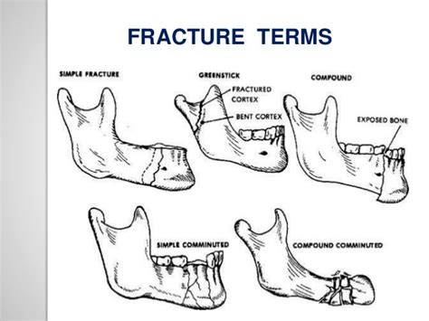 Mandible Fracture Types