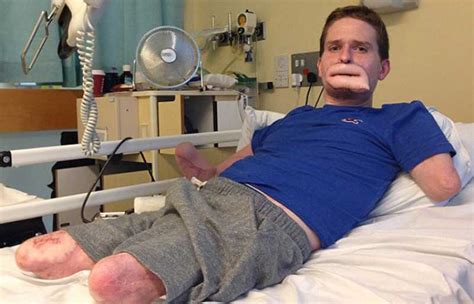 Alex Lewis, victim of flesh eating bacteria - Weird Picture Archive