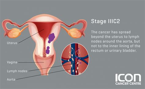 Uterine Cancer — Icon Cancer Centre Singapore